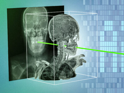 New AI technique could make minimally invasive surgeries safer and more precise | MIT News